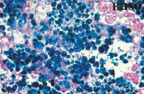 Hemosiderin Stain